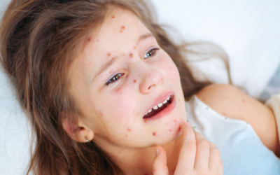 Chickenpox vaccines: what’s the latest?