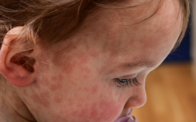 Rise in measles cases is causing concern